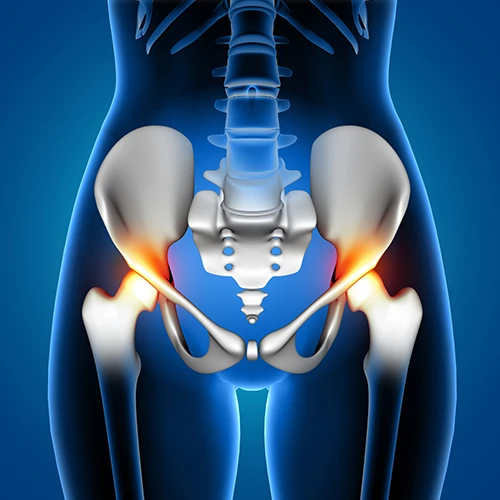 Total Hip Replacement