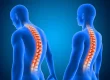 Scoliosis Img