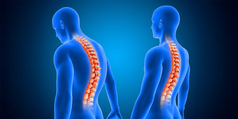 Scoliosis Img
