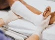 Fracture Management Treatment, Recovery & Healing Time