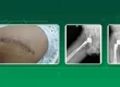 Hip Replacement Recovery