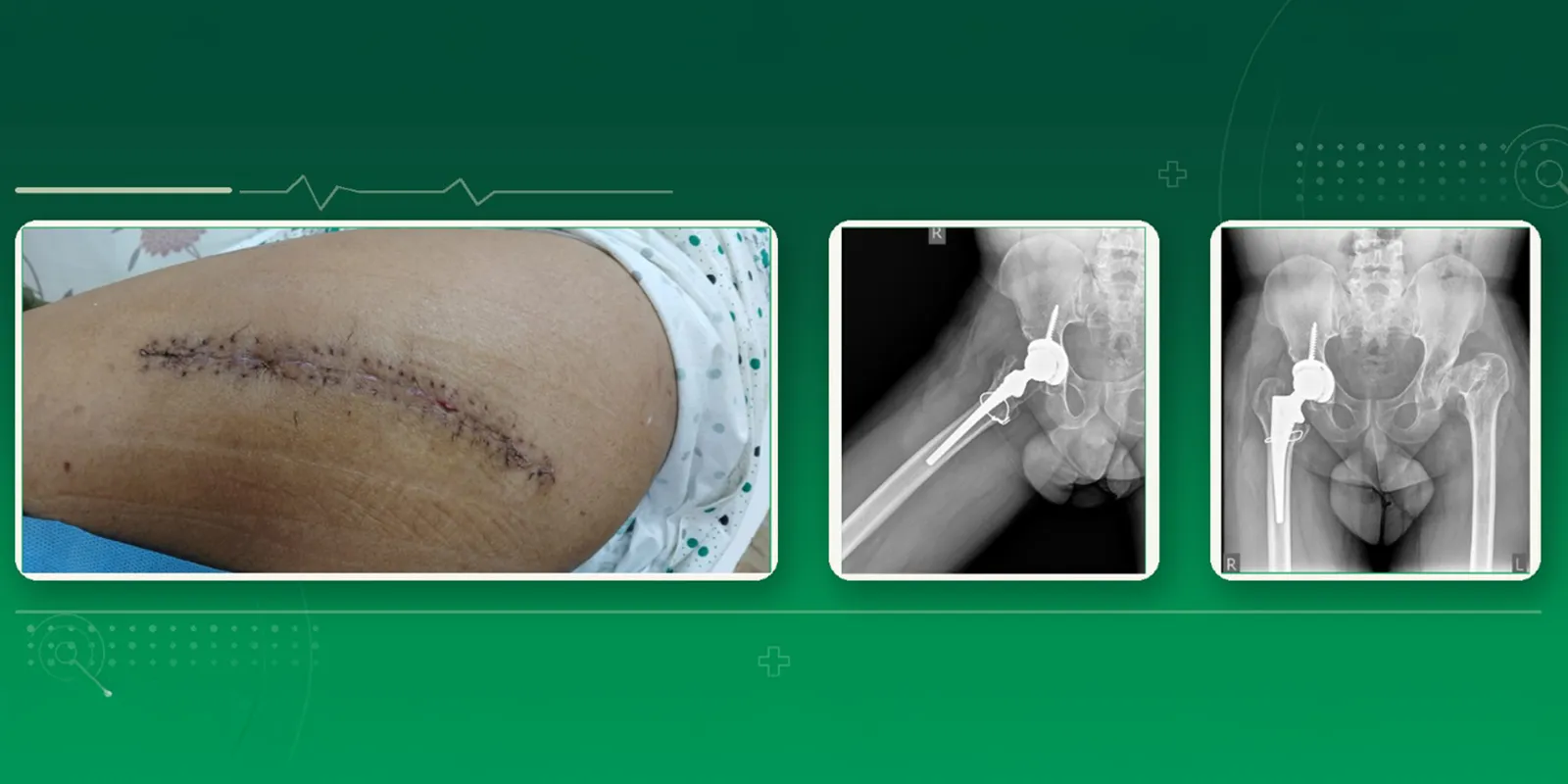 Hip Replacement Recovery