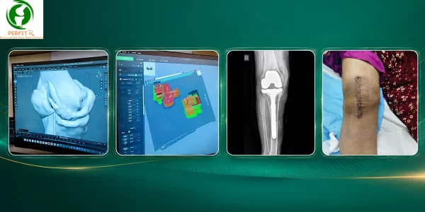 Personalized Knee System